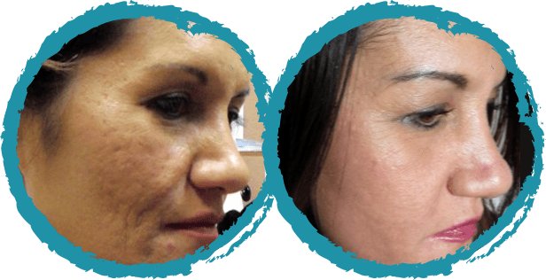 microneedling before and after 3