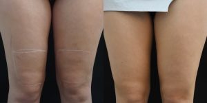 Profound RF Cellulite Before & After Gallery Patient 149342186 Image