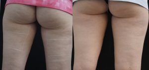 Profound RF Cellulite Before & After Gallery Patient 149342187 Image