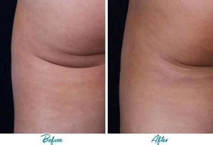 Profound RF Cellulite Before & After Gallery Patient 18616340 Image