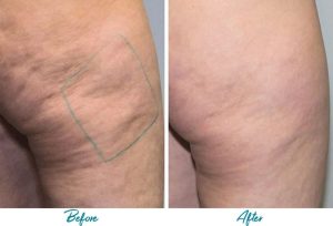 Profound RF Cellulite Before & After Gallery Patient 18616341 Image