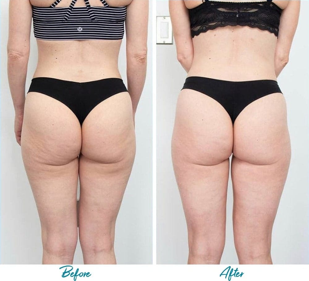 Profound RF Cellulite Before & After Gallery Patient 18616342 Image