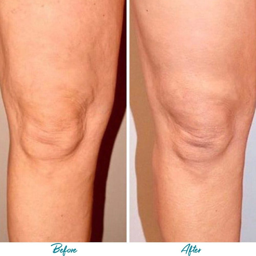 Profound RF Cellulite Before & After Gallery Patient 18616344 Image