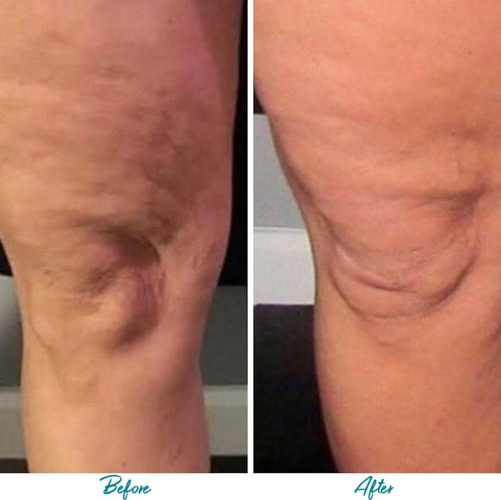 Profound RF Cellulite Before & After Gallery Patient 18616345 Image