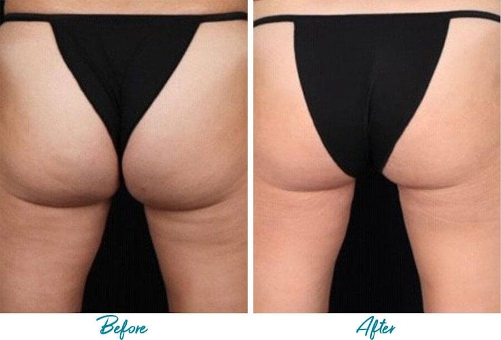 Profound RF Cellulite Before & After Gallery Patient 18616346 Image