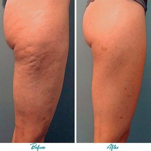 Profound RF Cellulite Before & After Gallery Patient 18616347 Image