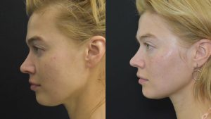 Profound RF Skin Tightening Before & After Gallery Patient 122206133 Image