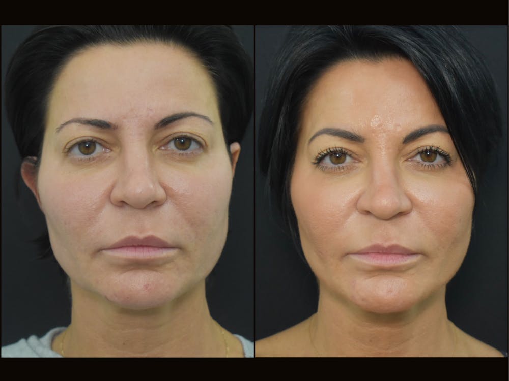 Profound RF Skin Tightening Before & After Gallery Patient 122206134 Image