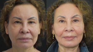 Profound RF Skin Tightening Before & After Gallery Patient 122206135 Image