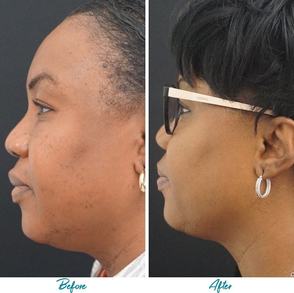 Profound RF Skin Tightening Before & After Gallery Patient 18616379 Image