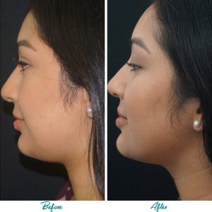 Profound RF Skin Tightening Before & After Gallery Patient 18616380 Image