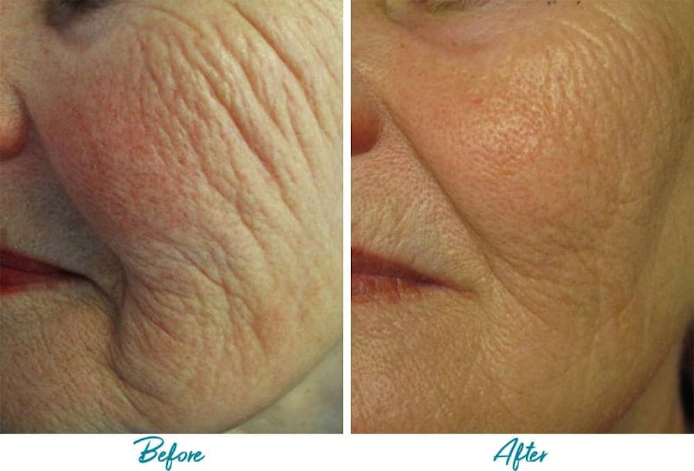 Profound RF Skin Tightening Before & After Gallery Patient 18616381 Image