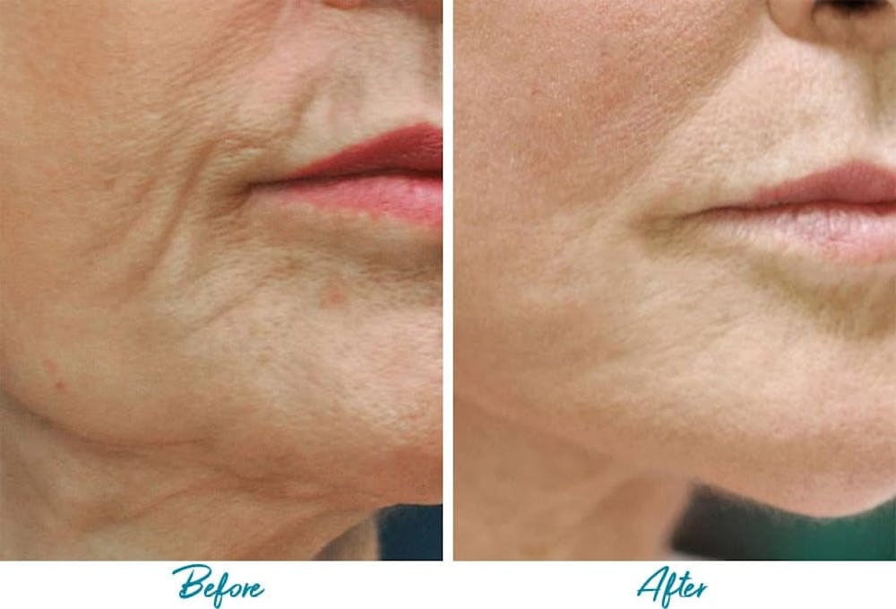 Profound RF Skin Tightening Before & After Gallery Patient 18616382 Image