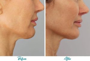 Profound RF Skin Tightening Before & After Gallery Patient 18616383 Image