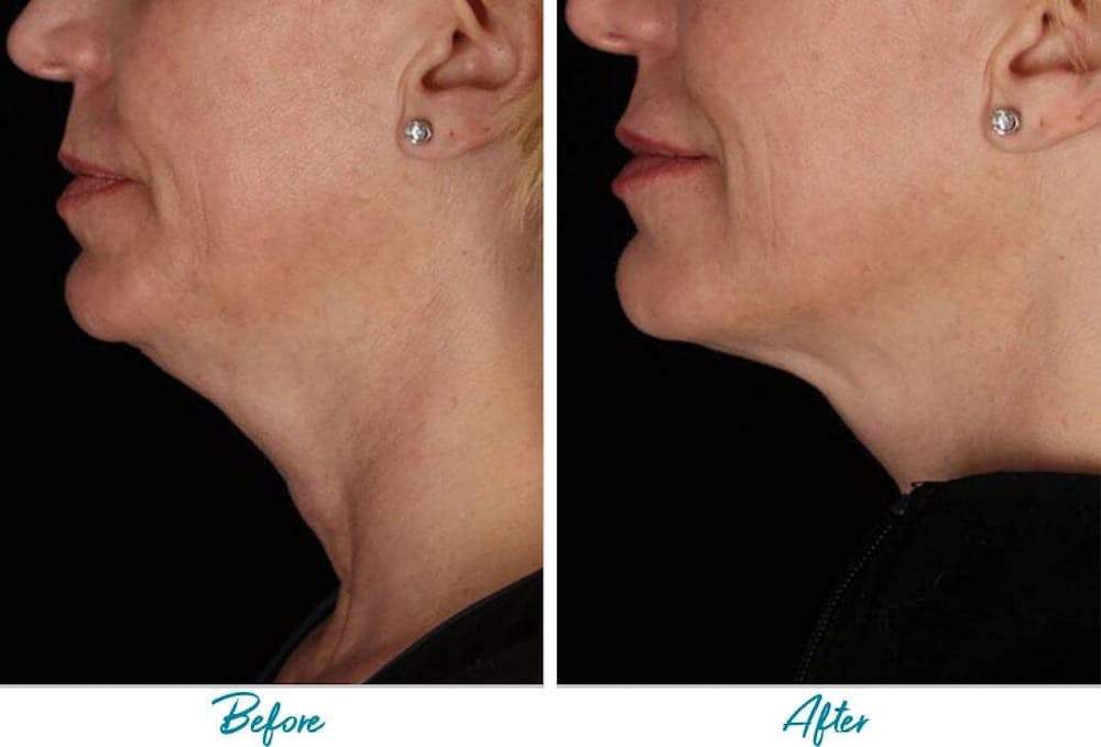 Profound RF Skin Tightening Before & After Gallery Patient 18616384 Image