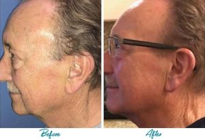 Profound RF Skin Tightening Before & After Gallery Patient 18616385 Image