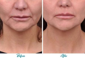 Profound RF Skin Tightening Before & After Gallery Patient 18616386 Image