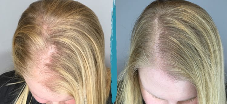 prp for hair loss before and after 01