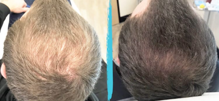 prp for hair loss before and after 02