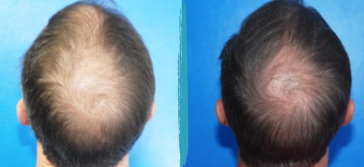 prp for hair loss before and after 04