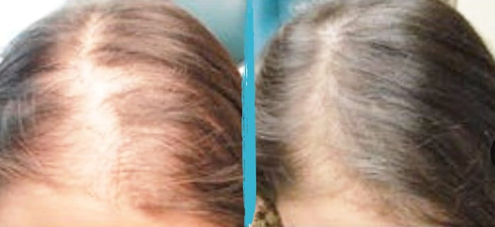 PRP Hair Loss Treatments Before & After Gallery Patient 18616197 Image