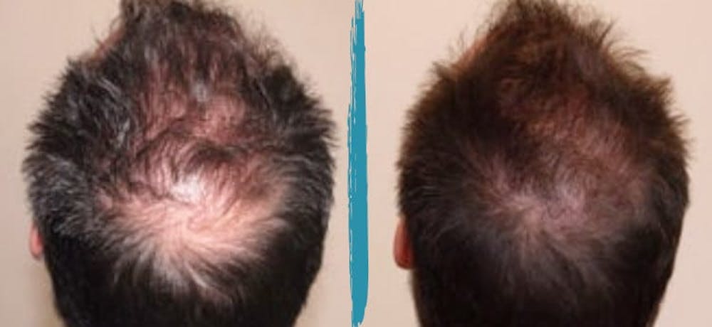 PRP Hair Loss Treatments Before & After Gallery Patient 18616199 Image