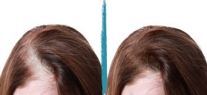 PRP Hair Loss Treatments Before & After Gallery Patient 18616200 Image