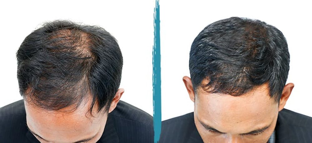 PRP Hair Loss Treatments Before & After Gallery Patient 18616201 Image