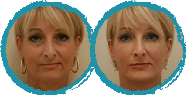 restylane before and after 1