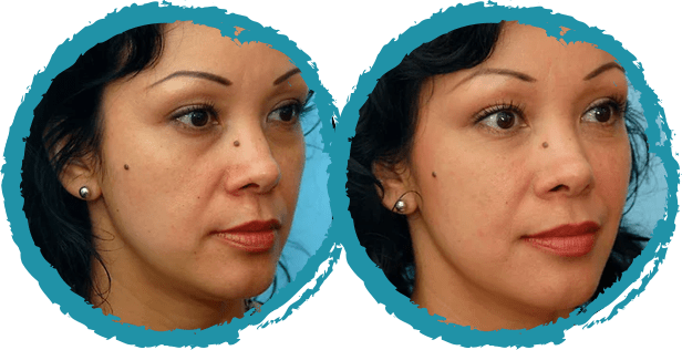 restylane before and after 2