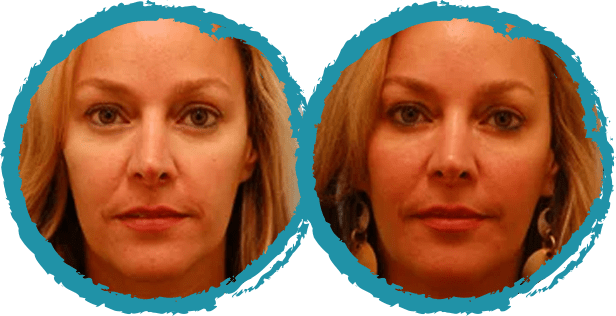 restylane before and after 3