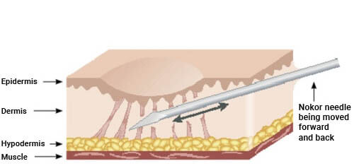 subcision acne scar new york city 1