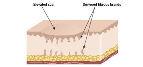 subcision acne scar new york city 3