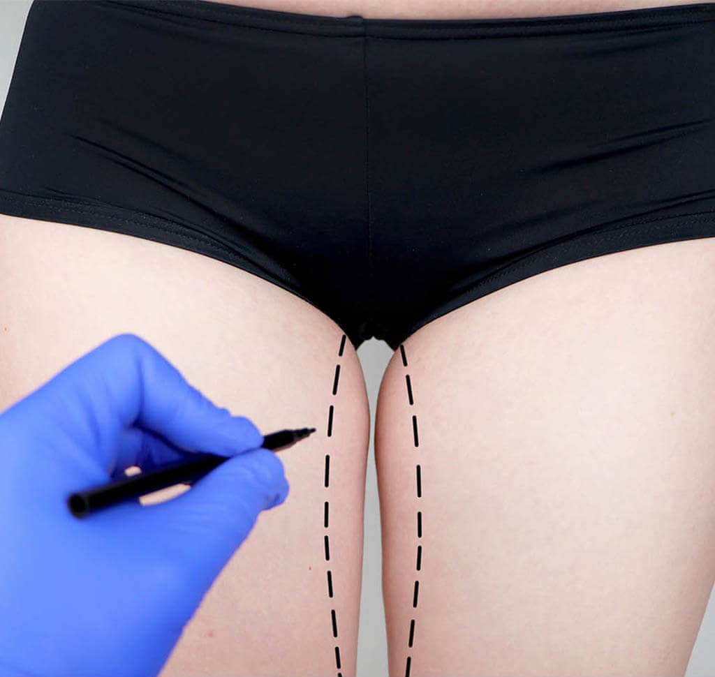 thighs liposuction nyc