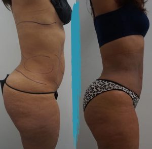 Vaser Lipo Before & After Gallery Patient 18616205 Image