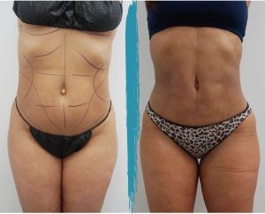 Vaser Lipo Before & After Gallery Patient 18616206 Image