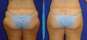 Vaser Lipo Before & After Gallery Patient 18616209 Image