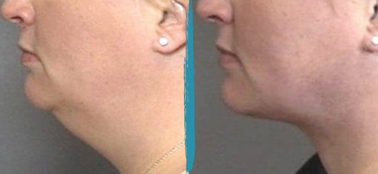 Vaser Lipo Before & After Gallery Patient 18616210 Image