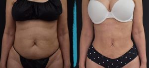 Vaser Lipo Before & After Gallery Patient 18616211 Image