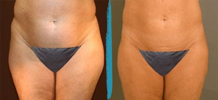 Vaser Lipo Before & After Gallery Patient 18616212 Image