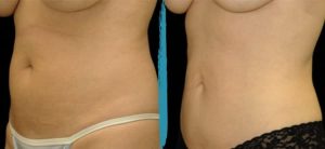 Vaser Lipo Before & After Gallery Patient 18616213 Image