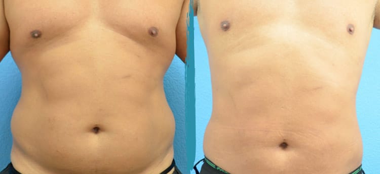 Vaser Lipo Before & After Gallery Patient 18616214 Image