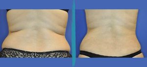 Vaser Lipo Before & After Gallery Patient 18616215 Image