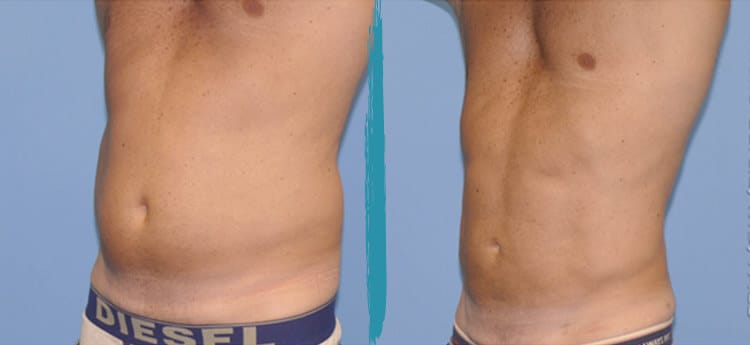 Vaser Lipo Before & After Gallery Patient 18616216 Image