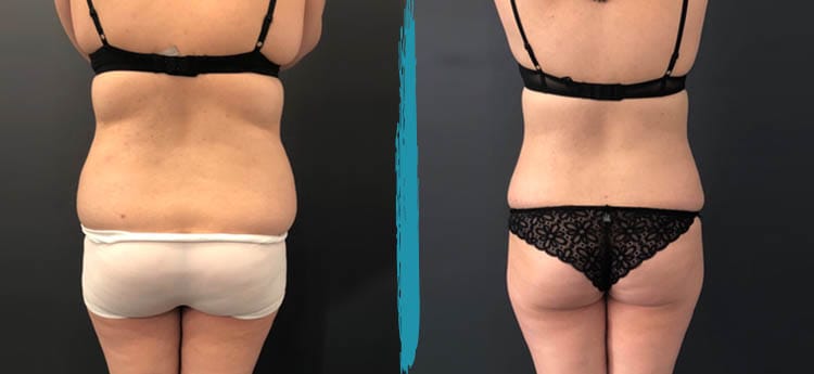 Vaser Lipo Before & After Gallery Patient 18616217 Image