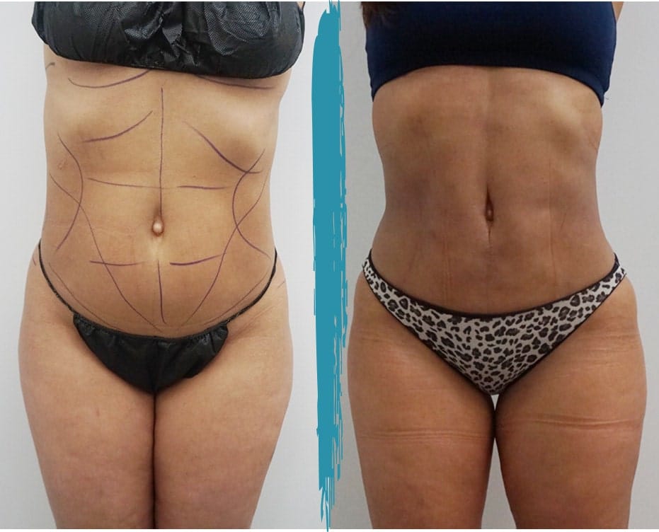 vaser liposuction nyc treatment