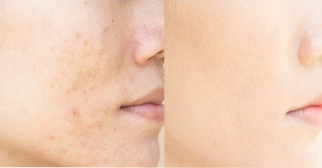 why to acne scars form