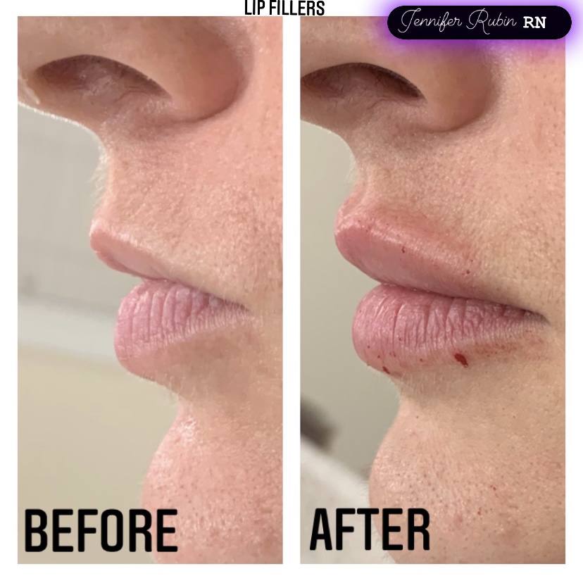 fillers before after gallery patient 122596980 image