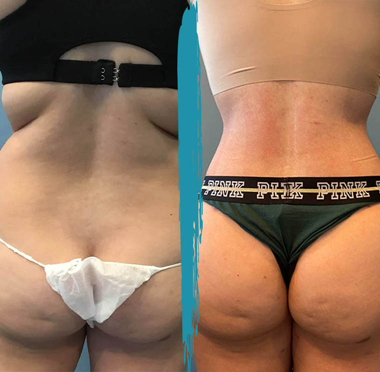 vaser lipo before after gallery patient 18616218 image