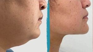 vaser lipo before after gallery patient 18616219 image